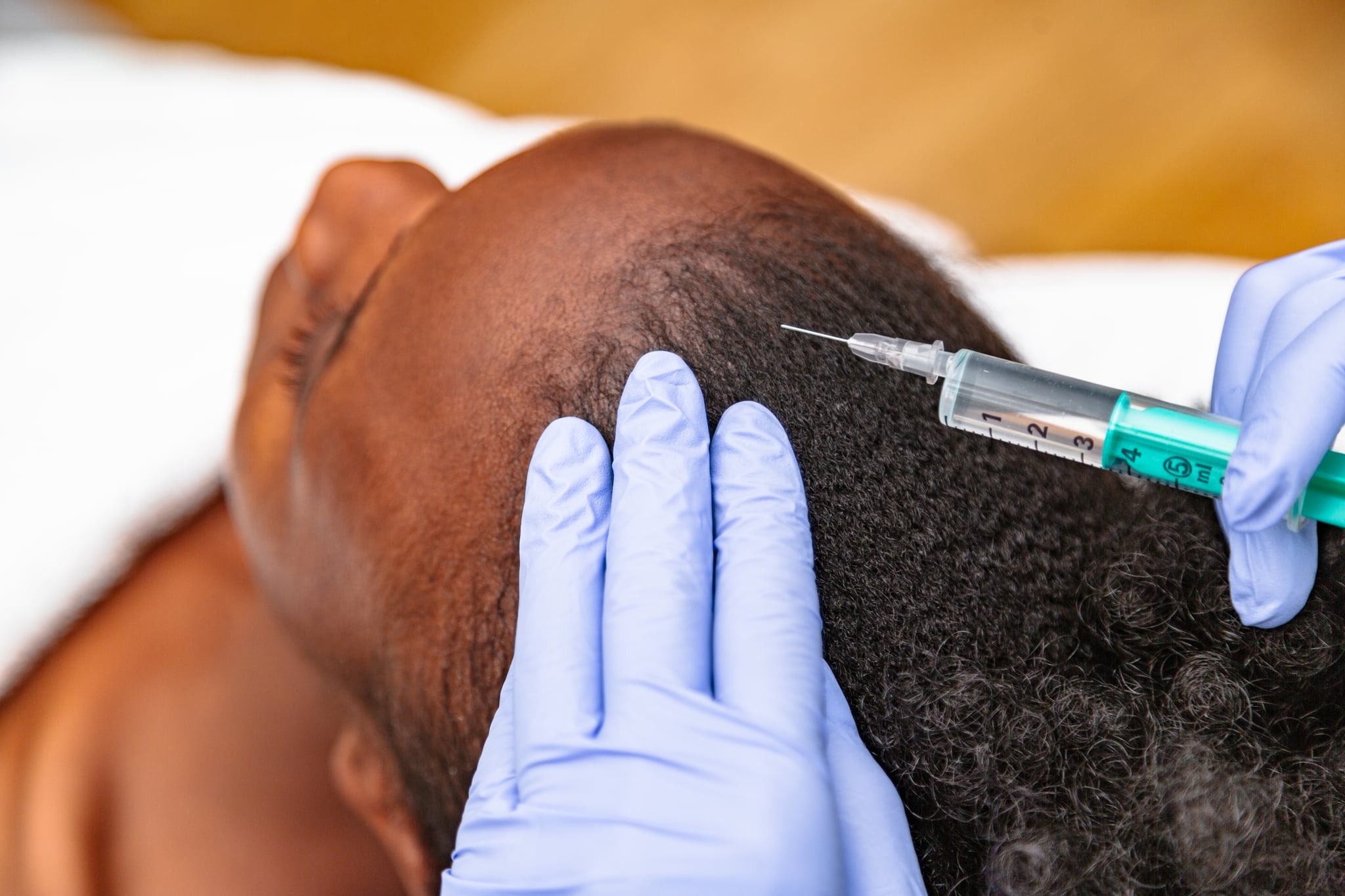 Женщинам делают инъекции ботокса по линии роста волос, чтобы сохранить края