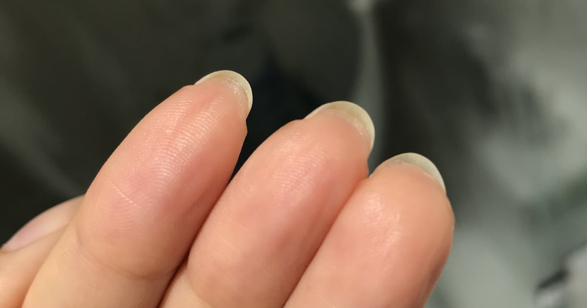 Причина роста кожи под ногтями