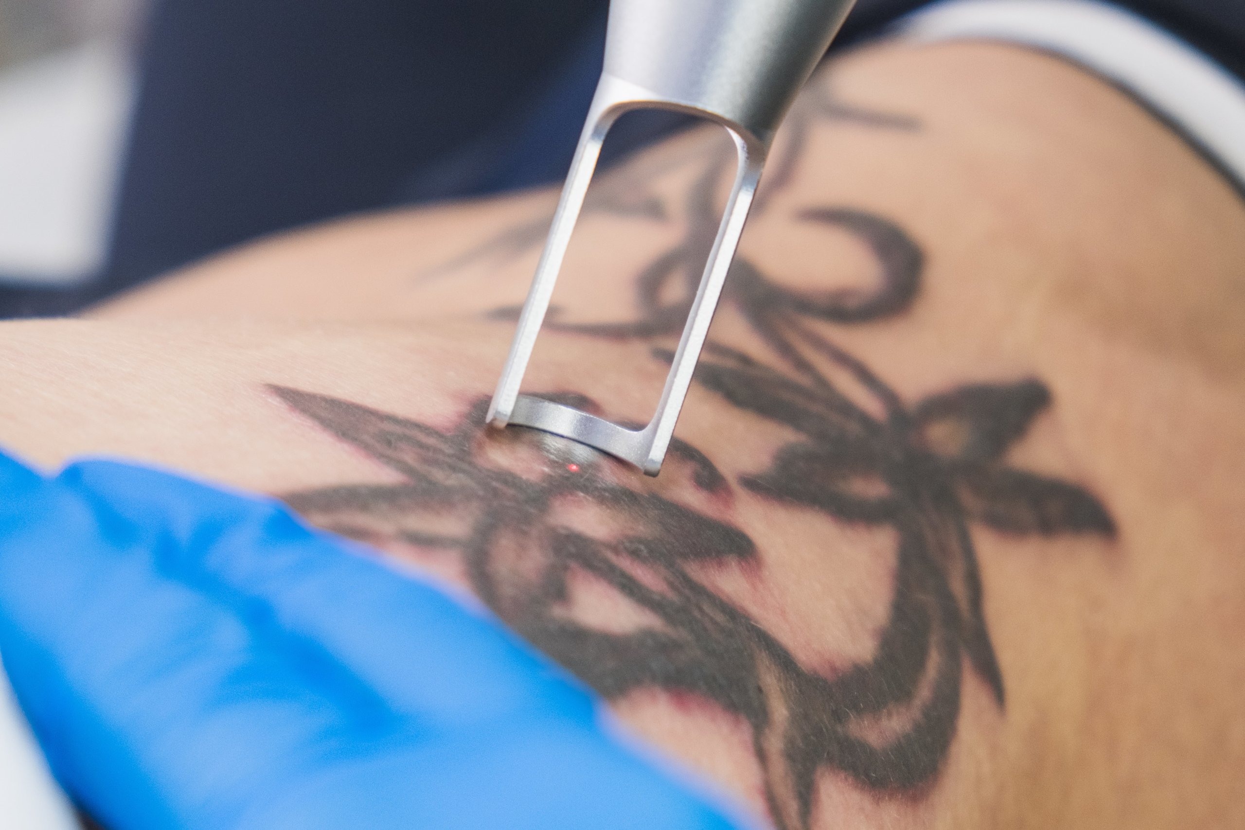 Больно ли удалять татуировки?  |