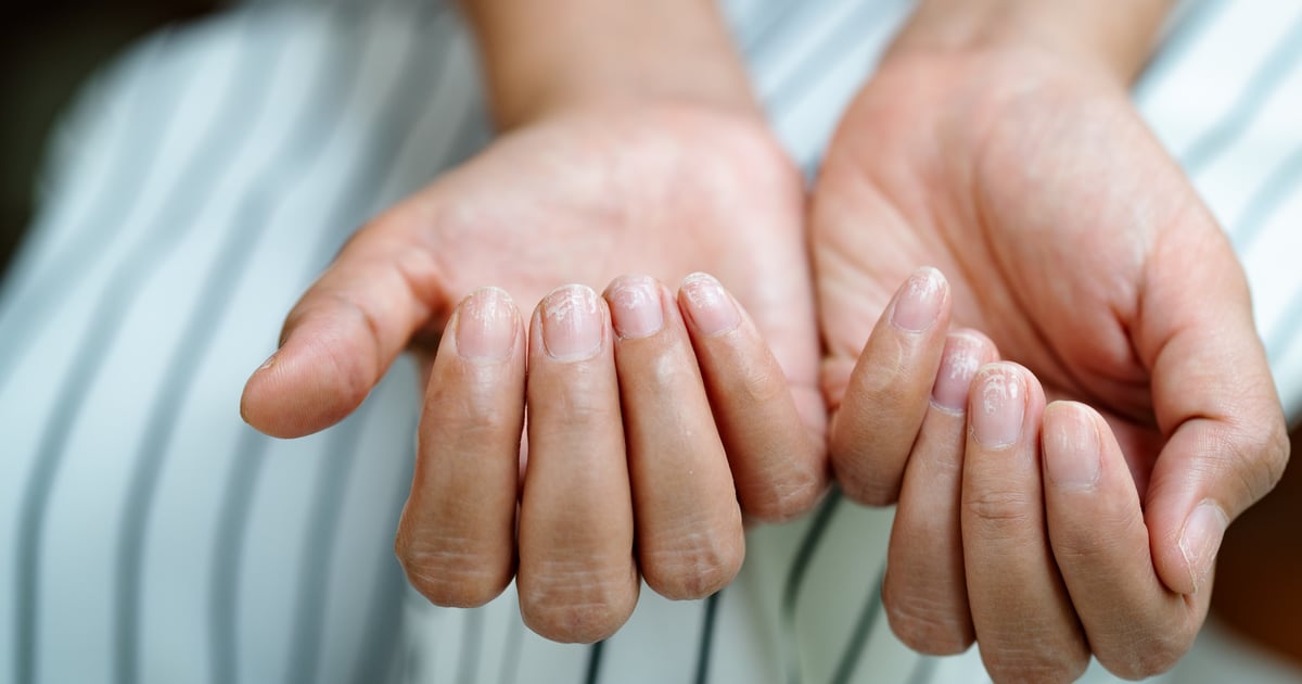 Шелушение ногтей: причины и лечение