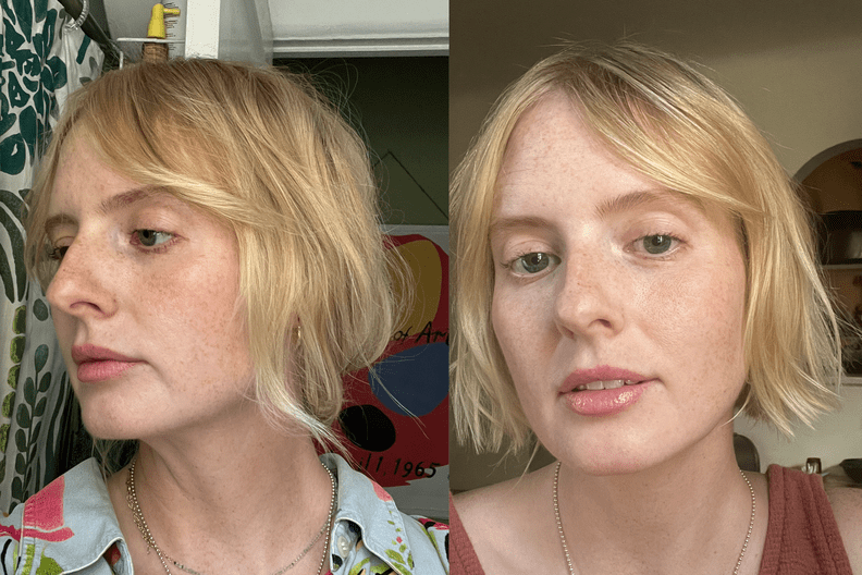 До и после процедуры подтяжки кожи Ellacore micro-coring