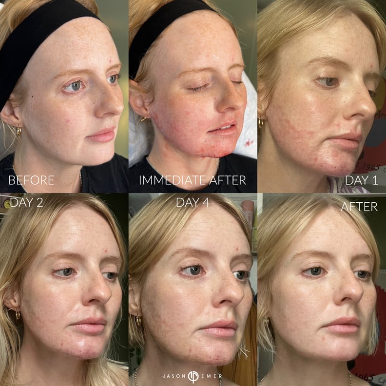 Фотографии прогресса после процедуры подтяжки кожи Ellacore